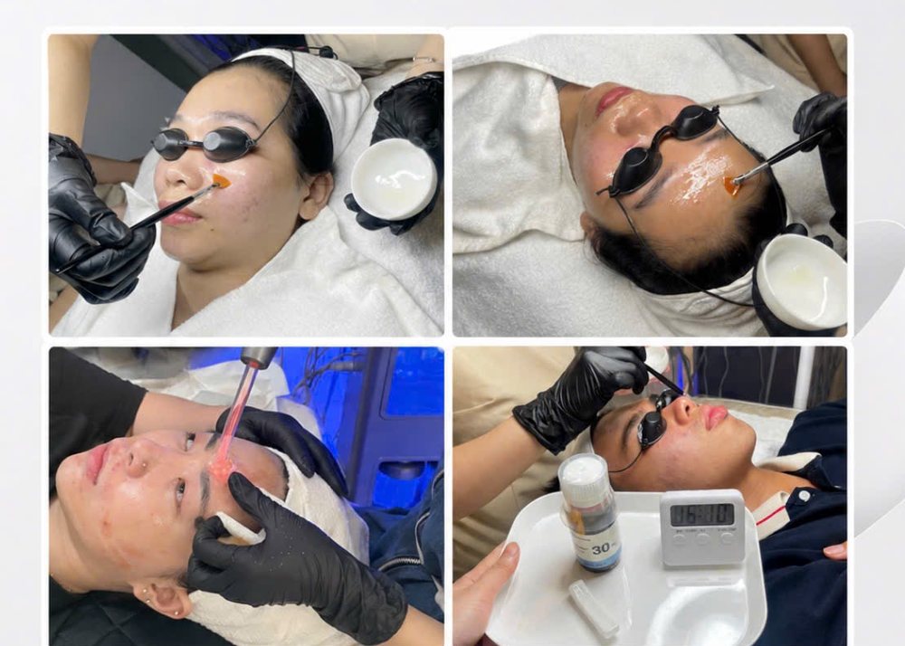 Các bước trong một buổi peel salicylic tại phòng khám